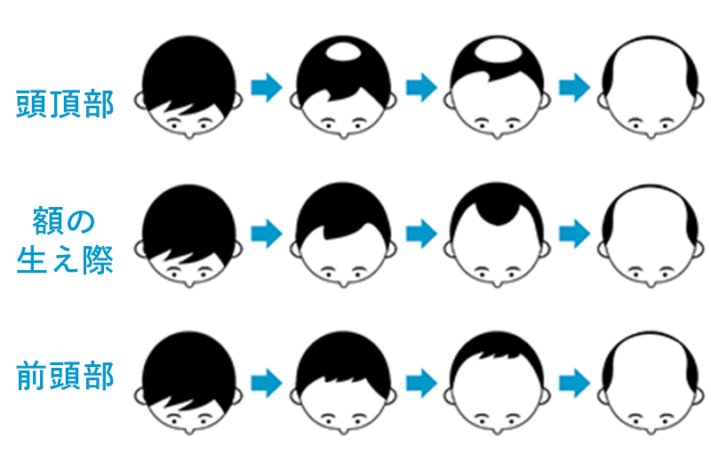 頭頂部、額の生え際、前頭部の進行
